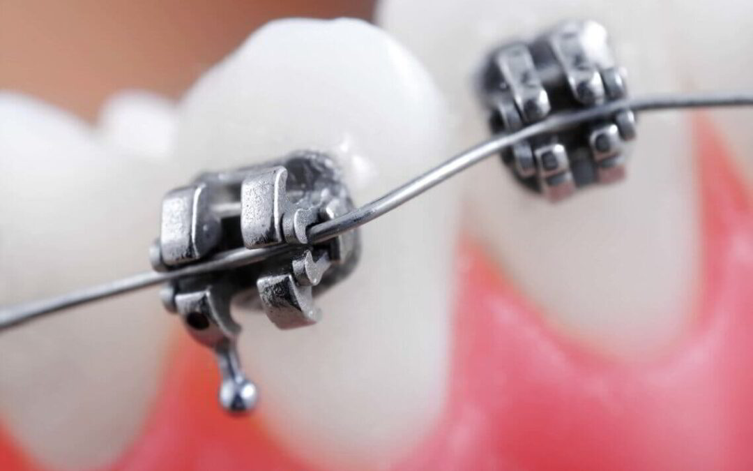 Brushing your teeth with braces