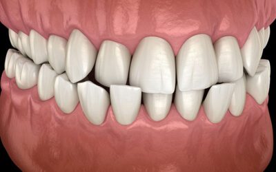 Cross-Bites and Bite Ramps