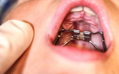 How MARPE Changes the Airway in Orthodontics