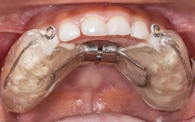 Orthodontic Appliances That Can Improve Sleep Apnea