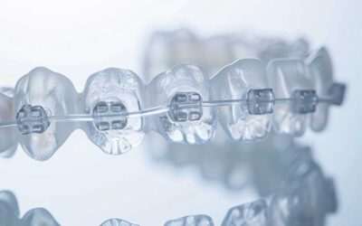 The Difference Between Lightforce Braces and Traditional Braces