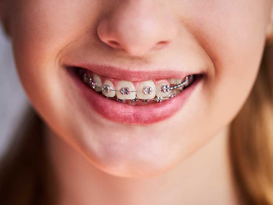 The Benefits of LightForce Braces to Patients
