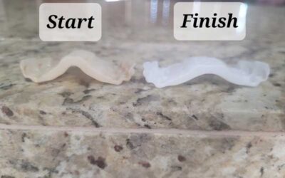 The Benefits of the Invisalign Palatal Expander Over the Rapid Palatal Expander