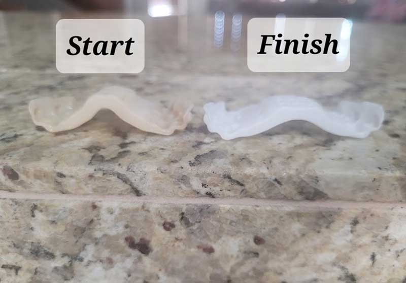 Palatal Expander System