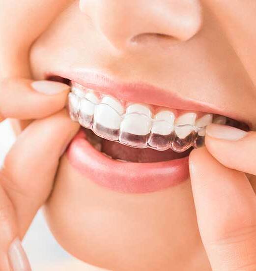 Invisalign Touch-up Treatment