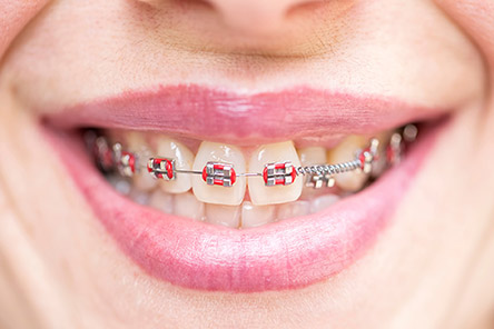 Traditional Braces